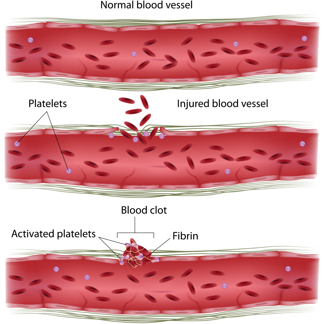 Nattokinase Helps Prevent Blood Clotting